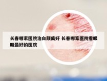 长春哪家医院治白颠疯好 长春哪家医院看眼睛最好的医院