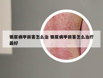 银屑病甲损害怎么治 银屑病甲损害怎么治疗最好