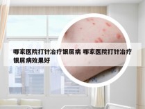 哪家医院打针冶疗银屑病 哪家医院打针冶疗银屑病效果好