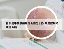 什么是牛皮肤癣用什么该怎麼办 牛皮肤癣又叫什么病