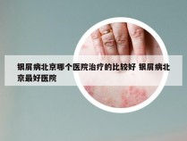 银屑病北京哪个医院治疗的比较好 银屑病北京最好医院