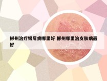 郴州治疗银屑病哪里好 郴州哪里治皮肤病最好