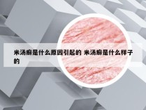 米汤癣是什么原因引起的 米汤癣是什么样子的