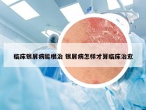 临床银屑病能根治 银屑病怎样才算临床治愈