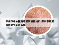 郑州市中心医院看银屑病挂啥科 郑州市银屑病研究中心怎么样