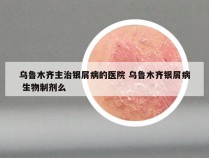 乌鲁木齐主治银屑病的医院 乌鲁木齐银屑病 生物制剂么