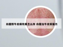 白醋擦牛皮癣效果怎么样 白醋治牛皮屑偏方