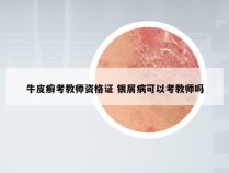 牛皮癣考教师资格证 银屑病可以考教师吗