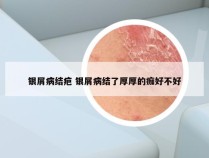 银屑病结疤 银屑病结了厚厚的痂好不好