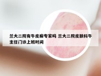 兰大二院有牛皮癣专家吗 兰大二院皮肤科牛主任门诊上班时间