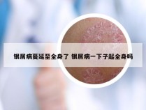 银屑病蔓延至全身了 银屑病一下子起全身吗