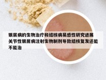 银屑病的生物治疗和结核病易感性研究进展 关节性银屑病注射生物制剂导致结核复发还能不能治