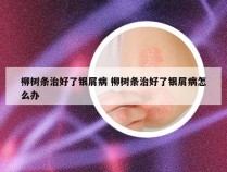 柳树条治好了银屑病 柳树条治好了银屑病怎么办