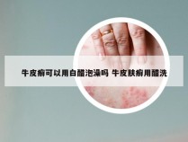 牛皮癣可以用白醋泡澡吗 牛皮肤癣用醋洗