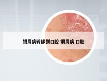 银屑病转移到口腔 银屑病 口腔