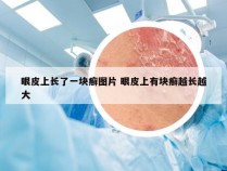 眼皮上长了一块癣图片 眼皮上有块癣越长越大