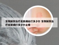 生物制剂治疗皮肤病给打多少针 生物制剂治疗皮肤病打多少针止痒