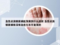 急性点滴银屑病能发展到什么症状 急性点滴银屑病有没有治愈几年不复发的