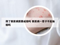 得了银屑病需要戒烟吗 银屑病一辈子不能抽烟吗