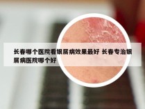 长春哪个医院看银屑病效果最好 长春专治银屑病医院哪个好