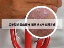 关节型银屑病腰疼 银屑病关节炎腰背疼