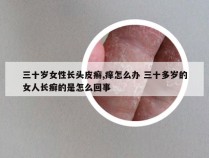 三十岁女性长头皮癣,痒怎么办 三十多岁的女人长癣的是怎么回事