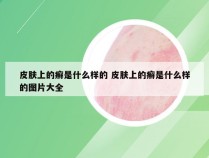 皮肤上的癣是什么样的 皮肤上的癣是什么样的图片大全