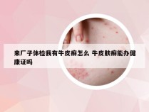 来厂子体检我有牛皮癣怎么 牛皮肤癣能办健康证吗