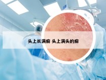 头上长满癣 头上满头的癣