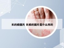 长的癣图片 长癣的图片是什么样的