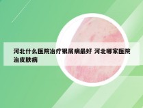 河北什么医院冶疗银屑病最好 河北哪家医院治皮肤病