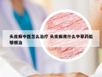 头皮癣中医怎么治疗 头皮癣用什么中草药能够根治