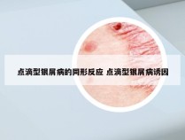 点滴型银屑病的同形反应 点滴型银屑病诱因