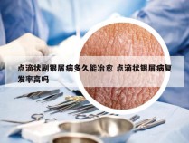 点滴状副银屑病多久能冶愈 点滴状银屑病复发率高吗