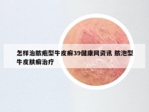 怎样治脓疱型牛皮癣39健康网资讯 脓泡型牛皮肤癣治疗