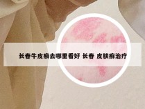 长春牛皮癣去哪里看好 长春 皮肤癣治疗