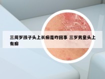 三周岁孩子头上长癣是咋回事 三岁男童头上有癣