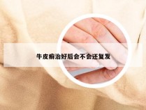 牛皮癣治好后会不会还复发