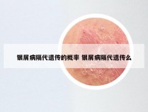 银屑病隔代遗传的概率 银屑病隔代遗传么