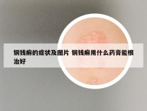 铜钱癣的症状及图片 铜钱癣用什么药膏能根治好