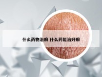 什么药物治癣 什么药能治好癣