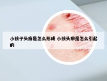 小孩子头癣是怎么形成 小孩头癣是怎么引起的