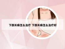 下肢长癣怎么治疗 下肢长癣怎么治疗好