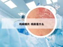 线癣图片 线藓是什么