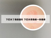 下巴长了像藓图片 下巴长得像癣一样瘙痒