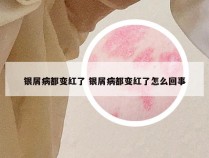 银屑病都变红了 银屑病都变红了怎么回事