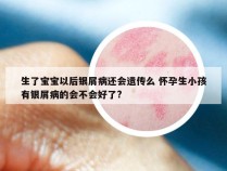 生了宝宝以后银屑病还会遗传么 怀孕生小孩有银屑病的会不会好了?