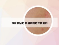 银屑病贴吧 银屑病贴吧生物制剂