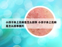 小孩子身上出癣是怎么回事 小孩子身上出癣是怎么回事图片