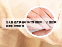 什么样的皮肤病可以打生物制剂 什么皮肤病需要打生物制剂